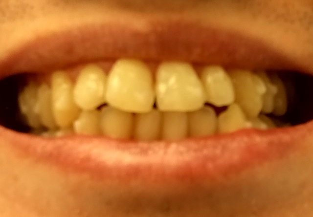開始直後の歯並び